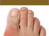 Home Remedies for Family Planning Gout Home Remedies 15 Proven Home Remedies for Gout with
